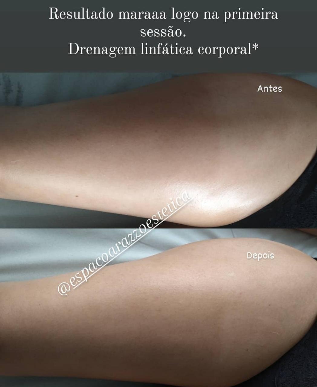 Drenagem Linfática Corporal