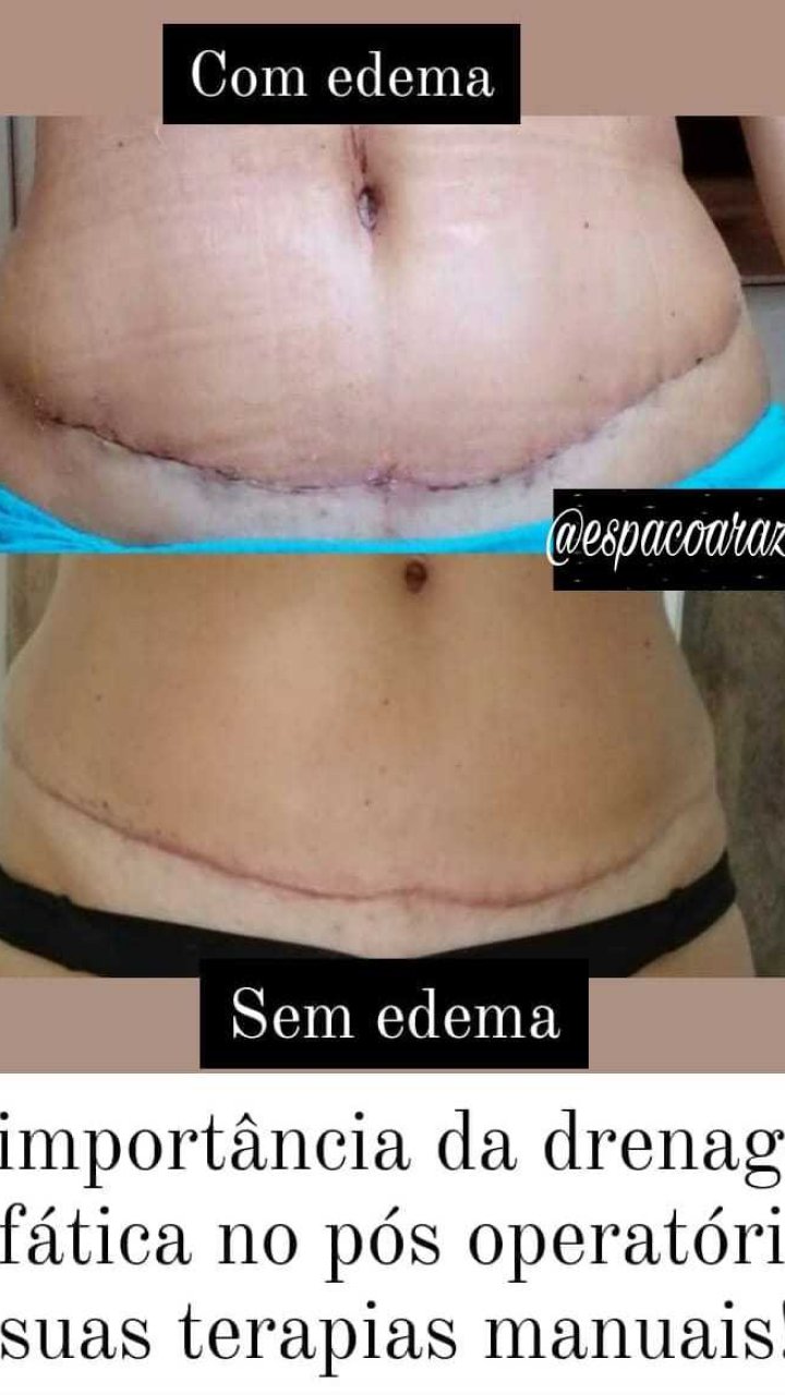Drenagem pós operatoria 1