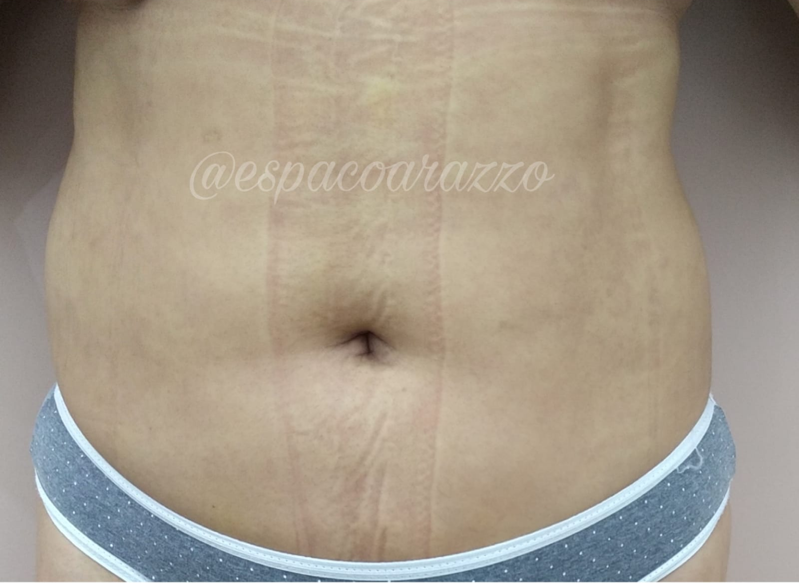 Lipoaspiração